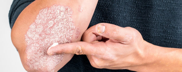 psoriasis